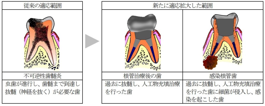歯髄再生治療の適応拡大