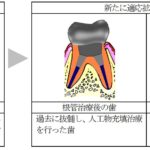 歯髄再生治療の対象疾患拡大