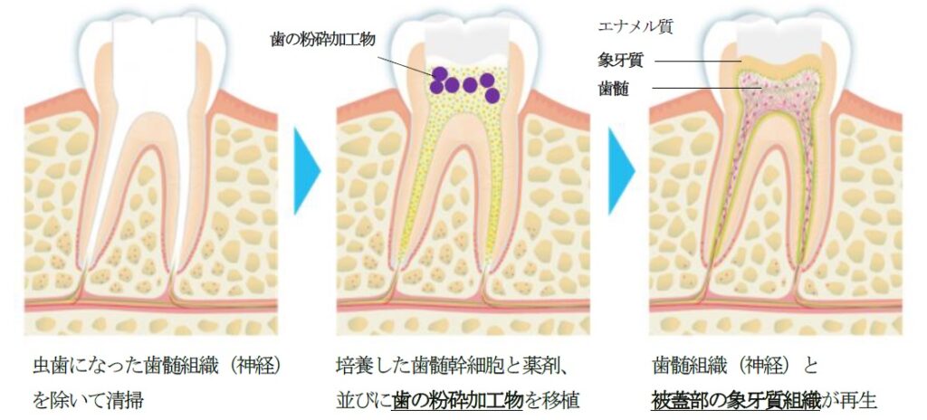 歯髄再生・象牙質再生治療の流れ